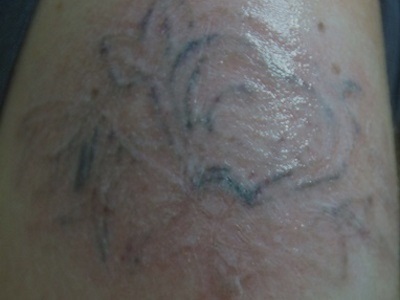Farbecht Tattoo - Tattoo-Entfernung nach erster Behandlung