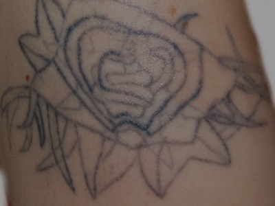 Farbecht Tattoo - Tattoo-Entfernung vor erster Behandlung